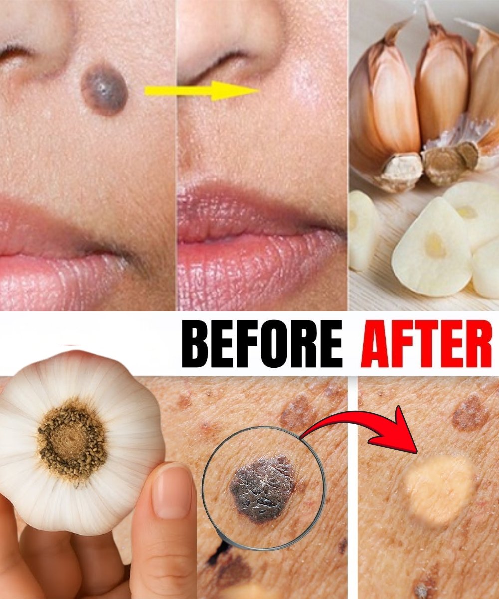 Garlic Remedy for Removing Moles and Skin Tags Naturally: What Works and What to Know