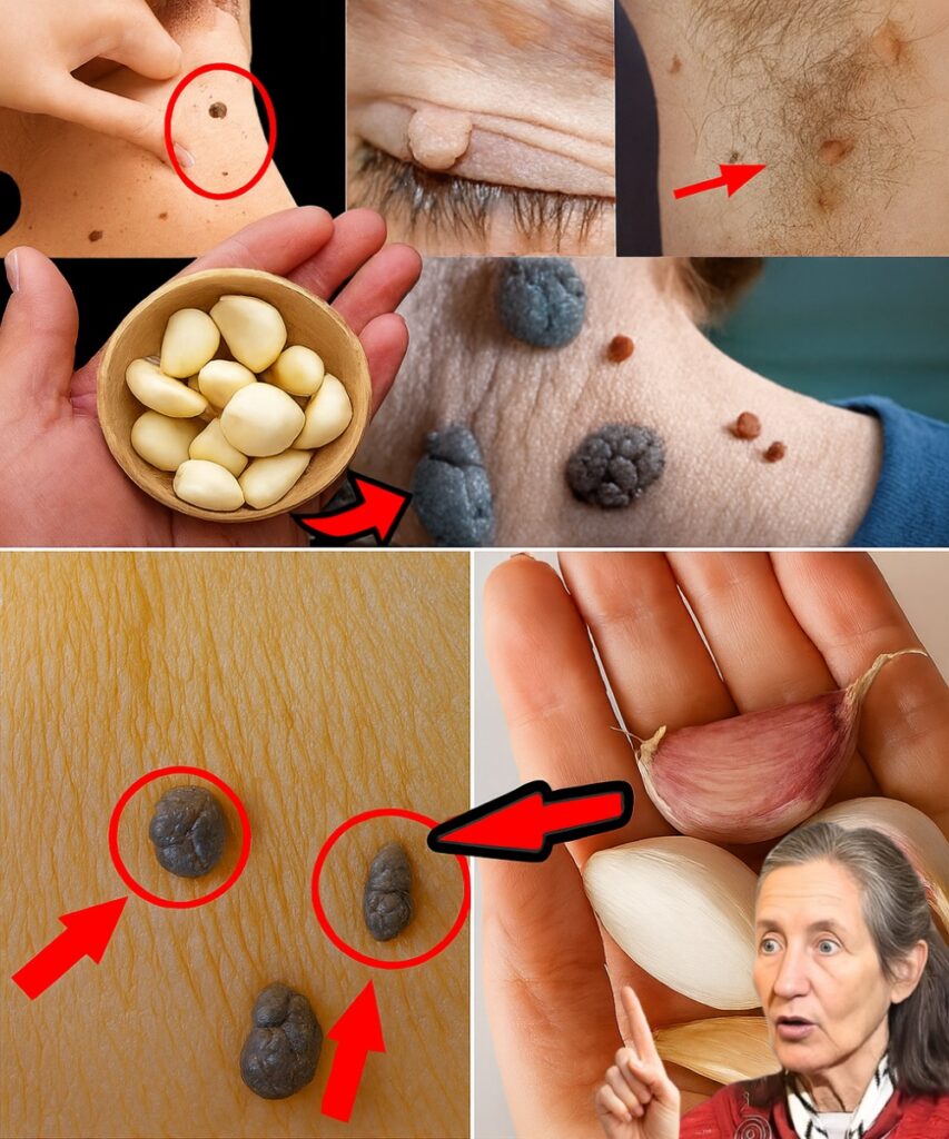 Garlic for Skin Tags: What You Really Need to Know Before Trying This Viral Home Remedy