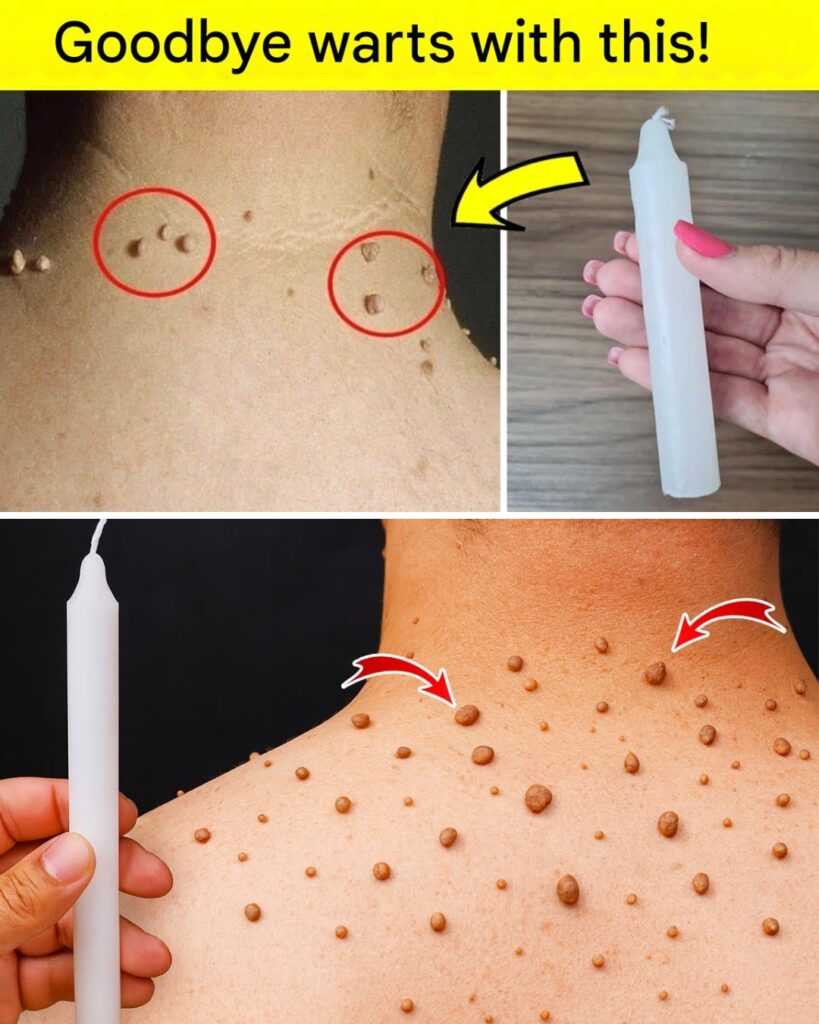 Say Goodbye to Warts Naturally: The Lemon-Based Remedy Everyone Is Talking About
