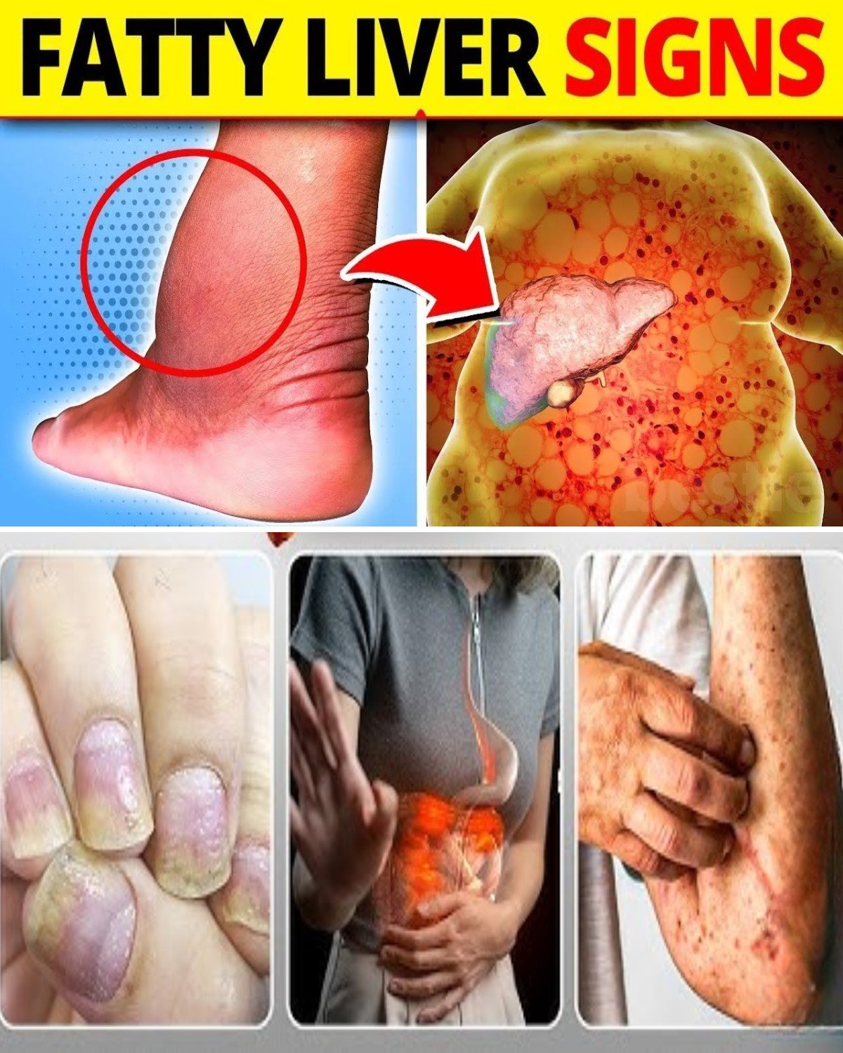 Don’t Ignore These 10 Subtle Symptoms That Could Signal Fatty Liver Concerns