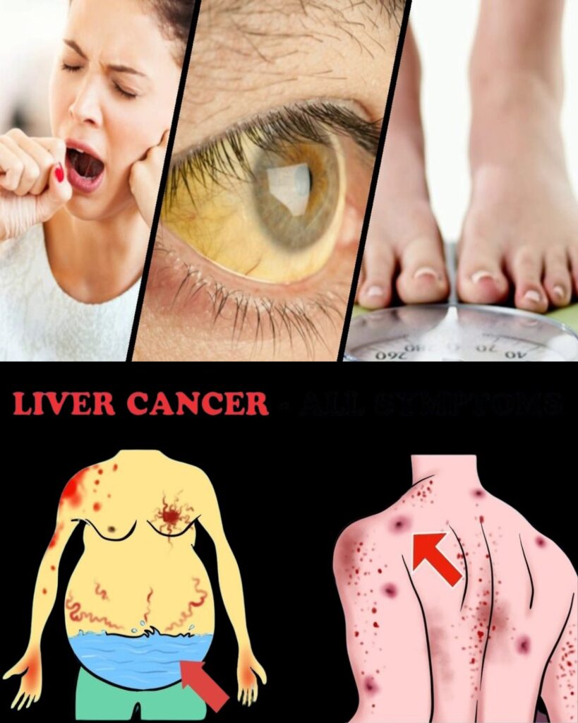 11 Warning Signs of Liver Cancer That You Should Not Ignore!