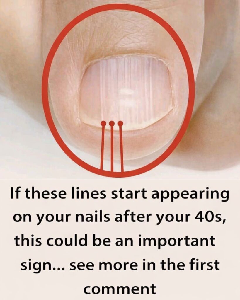 Vertical Lines on Your Nails After 40: A Warning Sign You Shouldn’t Ignore