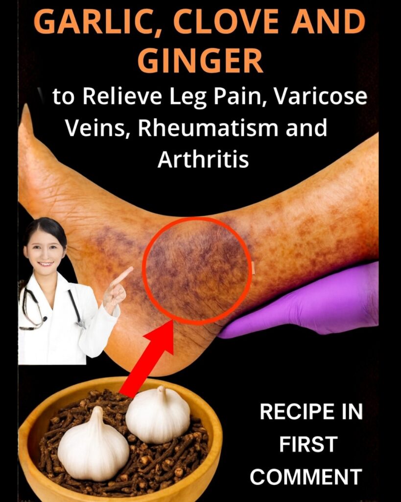 Garlic and Cloves: The Natural Remedy for Varicose Veins and Better Circulation