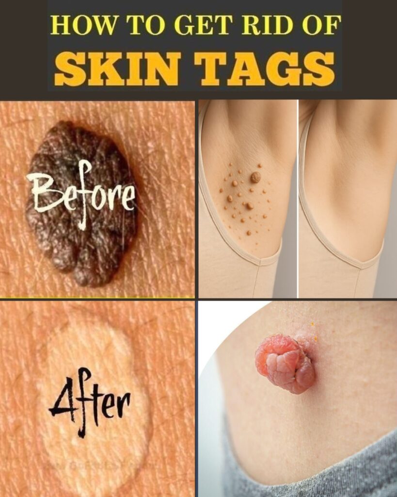 12 Home Remedies to Remove Skin Tags Naturally (Safe & Effective Methods)
