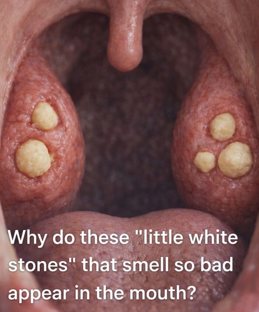 What Are Those Smelly “White Stones” in Your Mouth That Cause Terrible Bad Breath? (The Truth About Tonsil Stones)