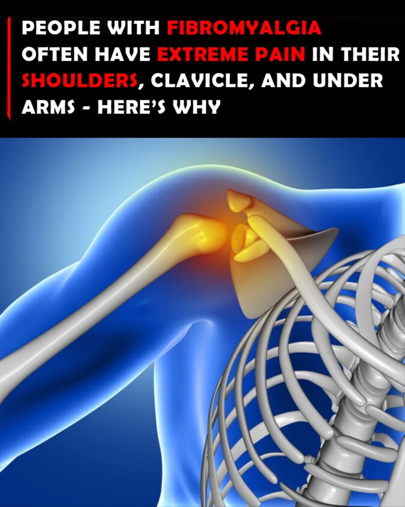 How Common Is Clavicle or Shoulder Pain in Fibromyalgia?