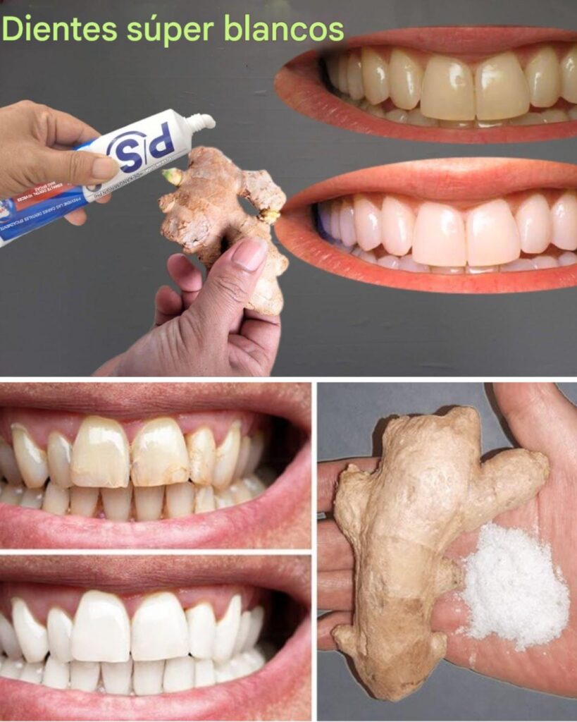 How to Remove Yellow Stains from Teeth at Home Using Ginger Cream, Baking Soda, and Vinegar