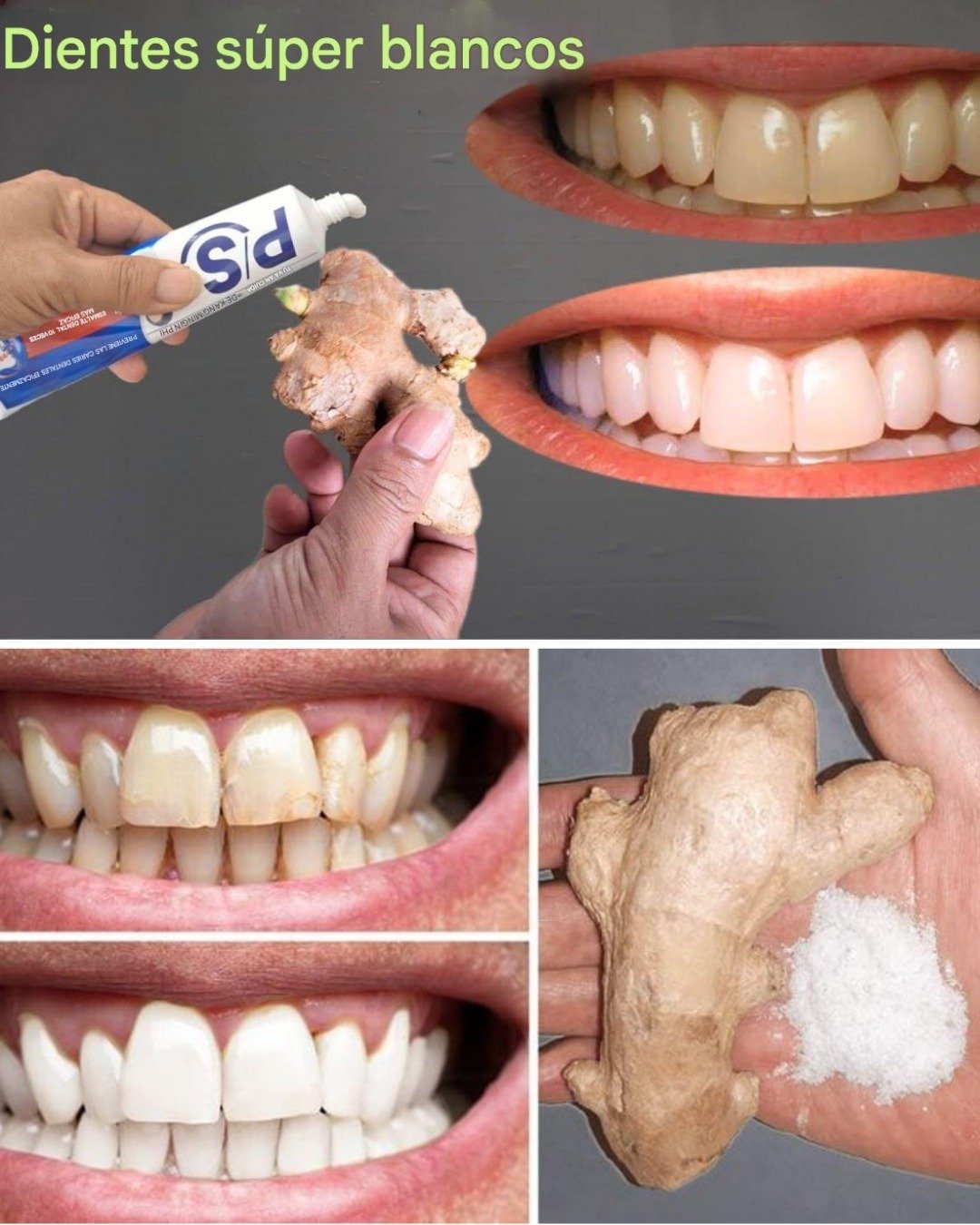 How to Remove Yellow Stains from Teeth at Home Using Ginger Cream, Baking Soda, and Vinegar