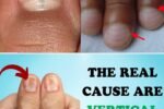 Are Deep Vertical Ridges on Your Nails Quietly Signaling a Hidden Health Crisis?