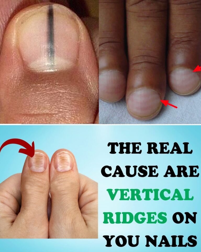 Are Deep Vertical Ridges on Your Nails Quietly Signaling a Hidden Health Crisis?