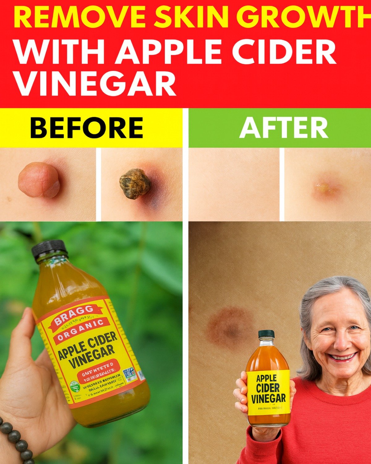 Natural Remedy for Warts and Skin Tags