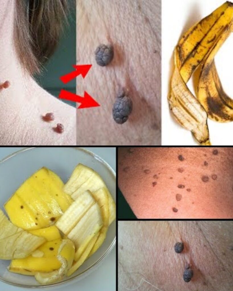 How to remove skin tag on face naturally!