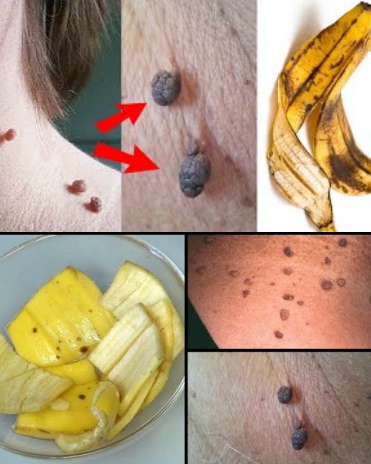How to remove skin tag on face naturally!