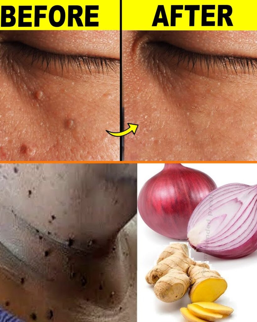 9 Effective Ways to Remove Skin Tags at Home