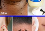  Overnight Miracle: The Vaseline Hack to Banish Skin Tags Instantly