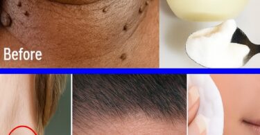  Overnight Miracle: The Vaseline Hack to Banish Skin Tags Instantly
