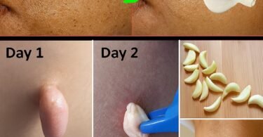 Those Stubborn Little White Bumps: Understanding Milia and Safe Ways to Improve Your Skin’s Appearance