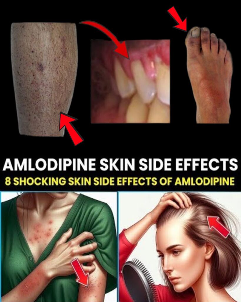 8 Amlodipine Skin Side Effects Your Doctor Might Not Warn You About