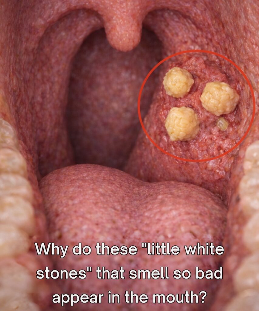 What Are Those Small White Stones in Your Throat That Cause Bad Breath?