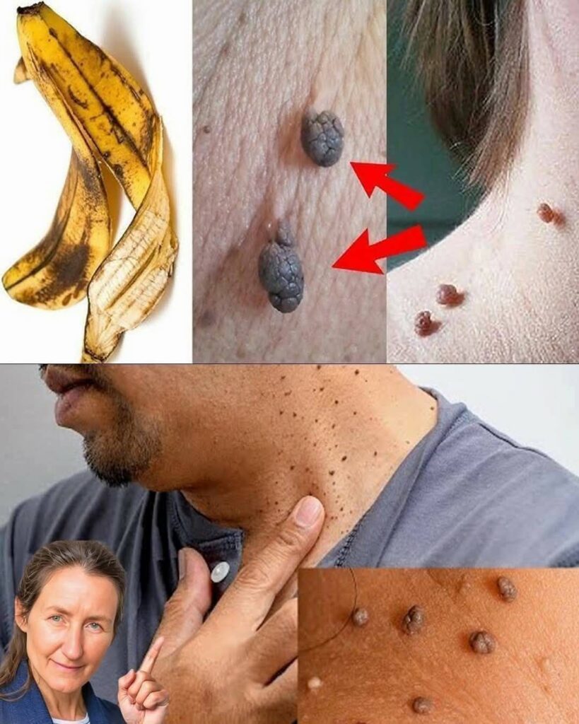 How to Remove Skin Tags Naturally Using Banana Peel
