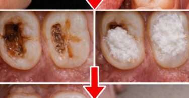 5 Simple Natural Home Remedies to Help Prevent Cavities and Support Healthy Teeth