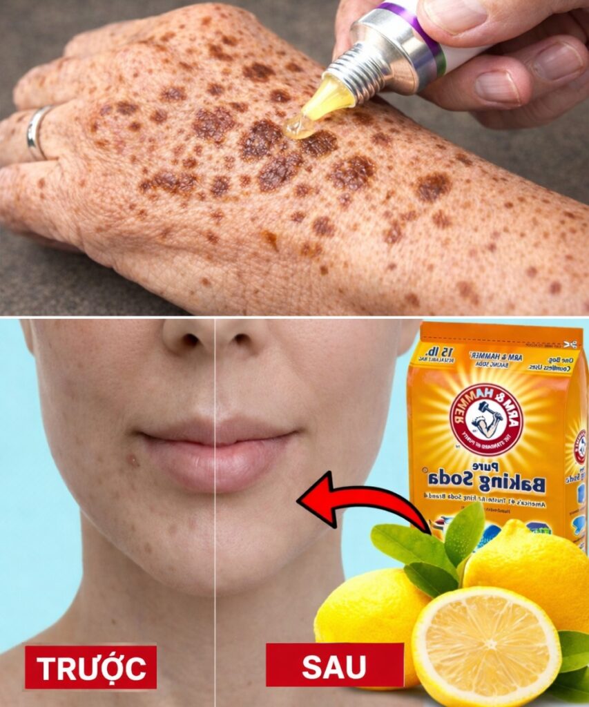 How to Remove Age Spots, Melasma, Sun Spots, Dark Marks, and Signs of Skin Aging Naturally