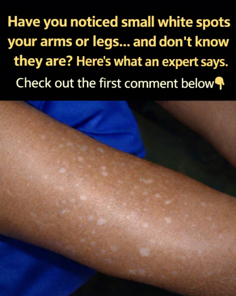 Have You Noticed Small White Spots on Your Arms or Legs and Wondered What They Could Be?