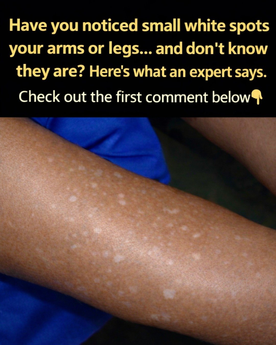 Have You Noticed Small White Spots on Your Arms or Legs and Wondered What They Could Be?