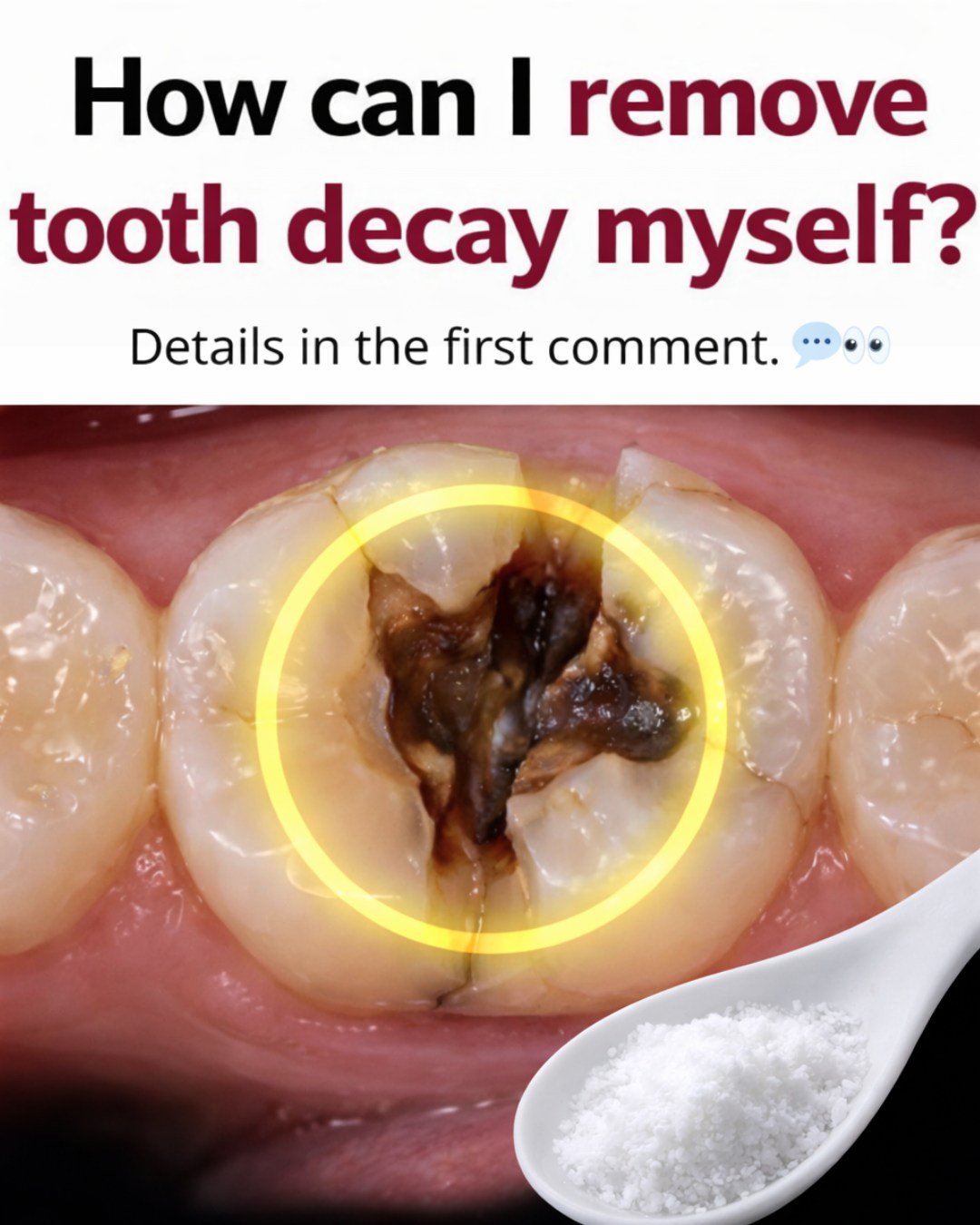 How Can I Remove Tooth Decay Myself? The Honest Truth (And What Actually Works)