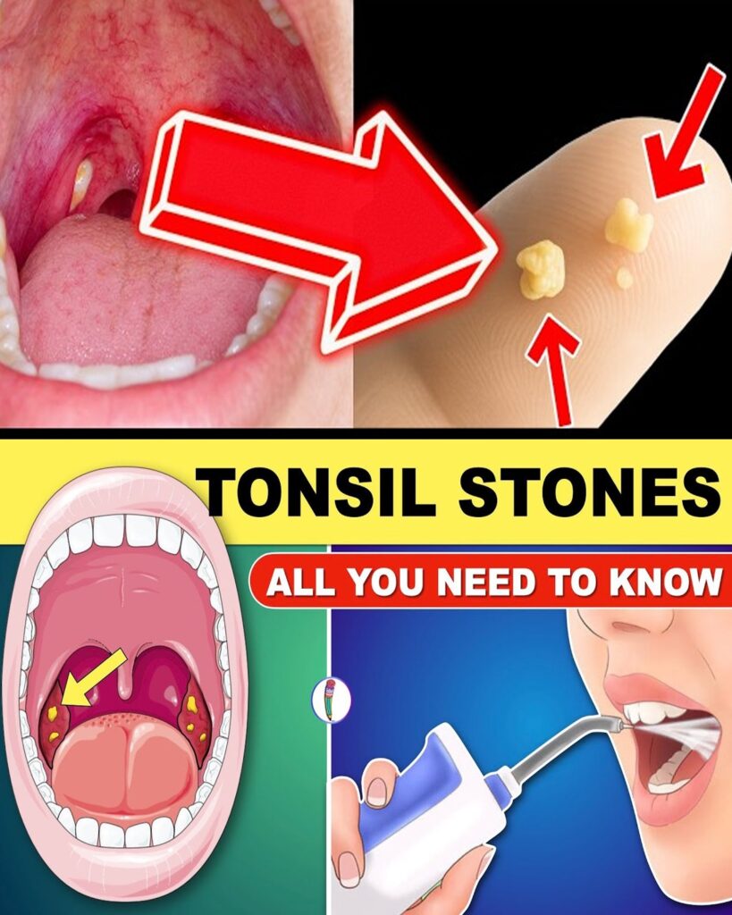 Tonsil Stones Unveiled: The Hidden Cause of Bad Breath and Throat Discomfort You Never Saw Coming