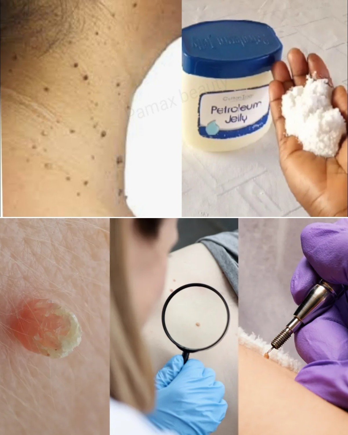 How to Remove Skin Tags in One Night Naturally at Home (Yes, Even With Something as Simple as Vaseline)