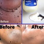 Those Stubborn Little White Bumps: Understanding Milia and Safe Ways to Improve Your Skin’s Appearance