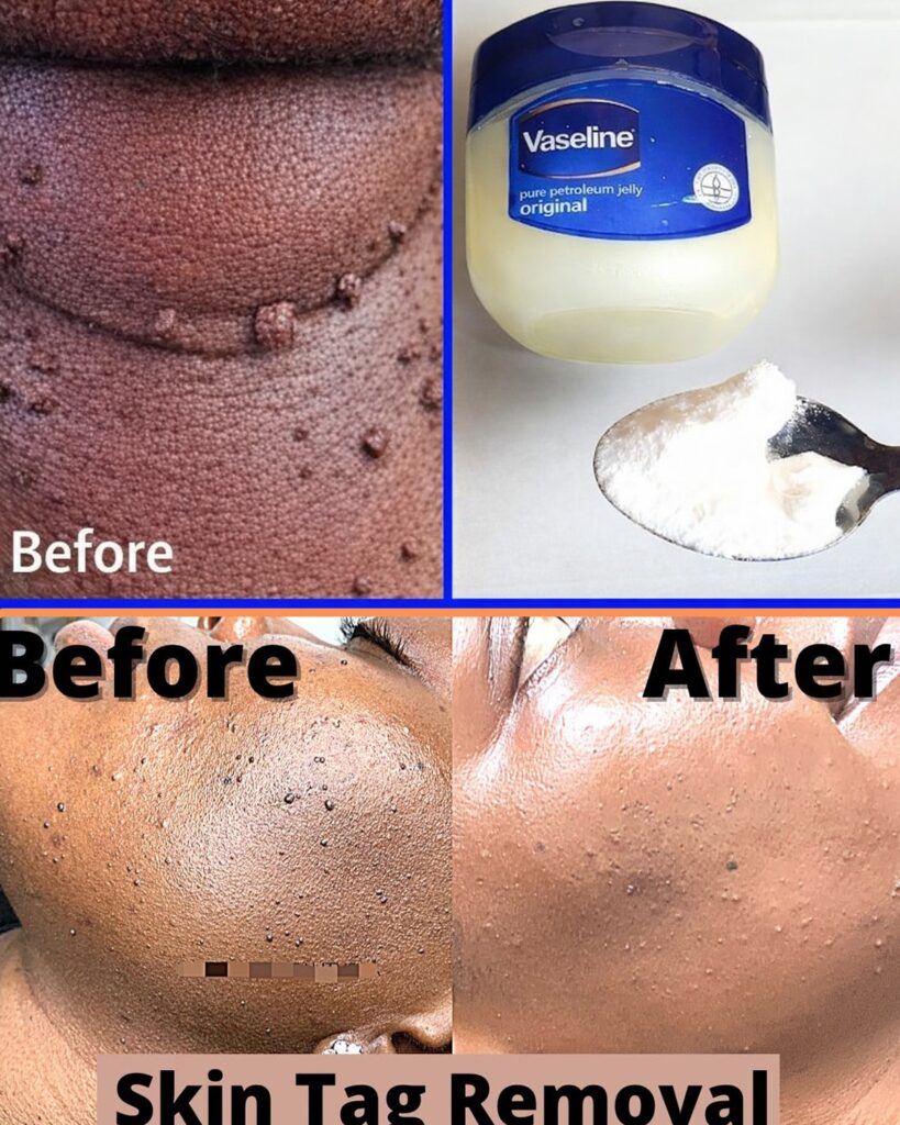 Those Stubborn Little White Bumps: Understanding Milia and Safe Ways to Improve Your Skin’s Appearance