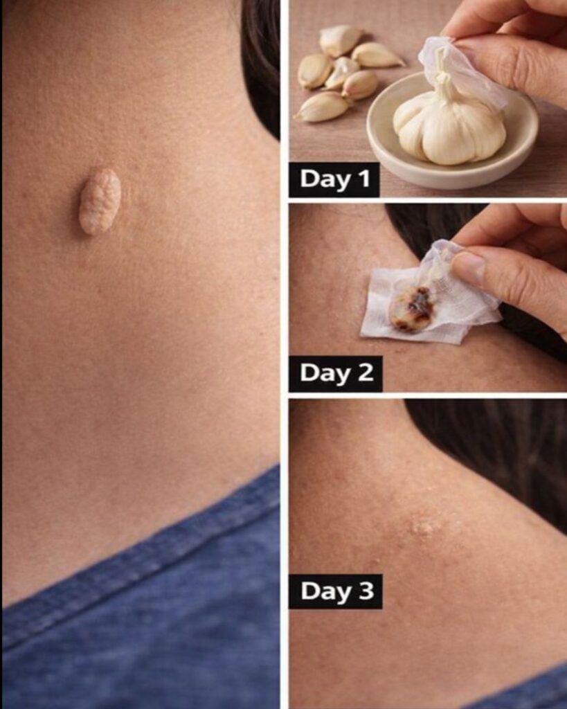 Garlic for Skin Tags? What You Need to Know Before Trying This Popular Home Remedy!