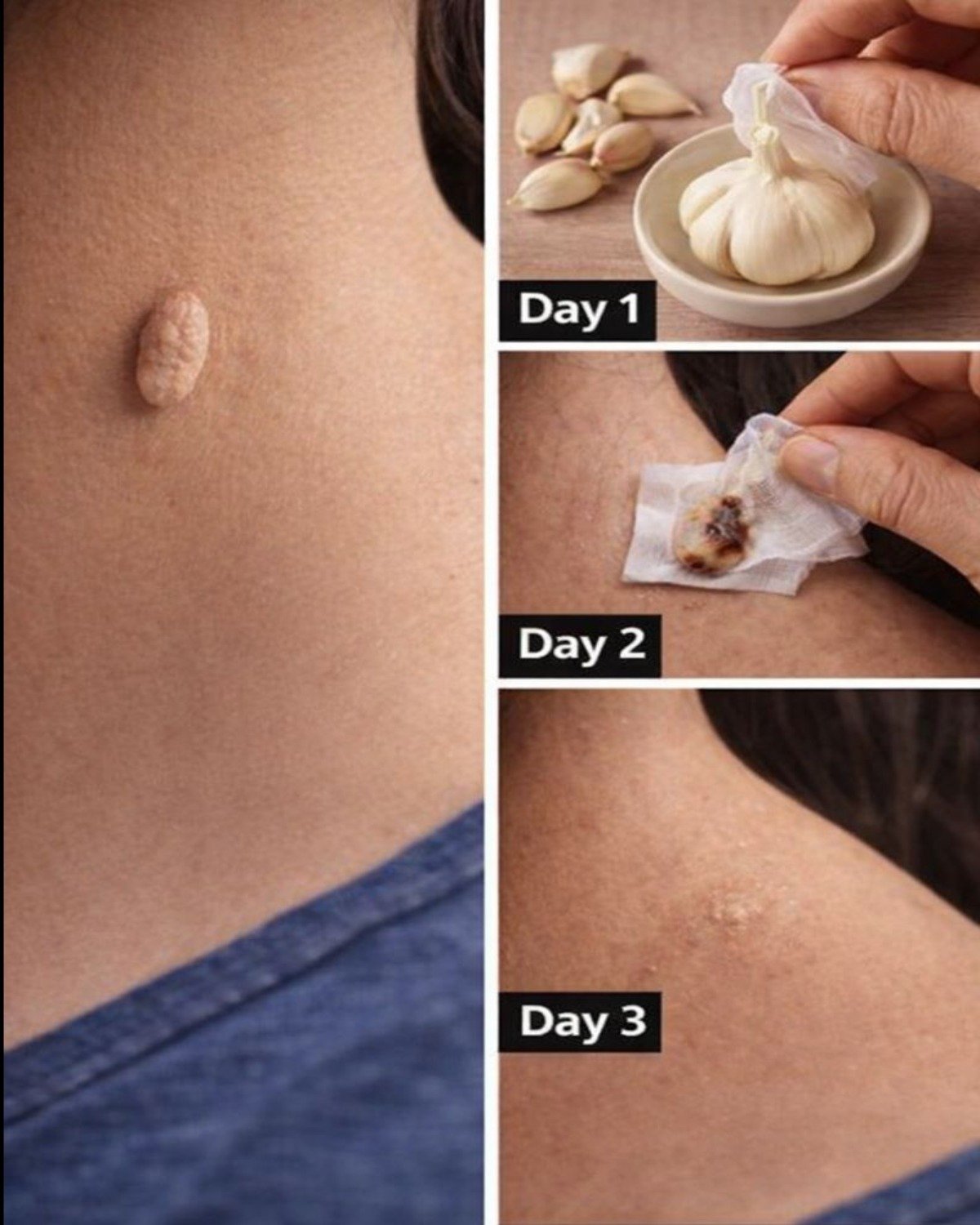 Garlic for Skin Tags? What You Need to Know Before Trying This Popular Home Remedy!