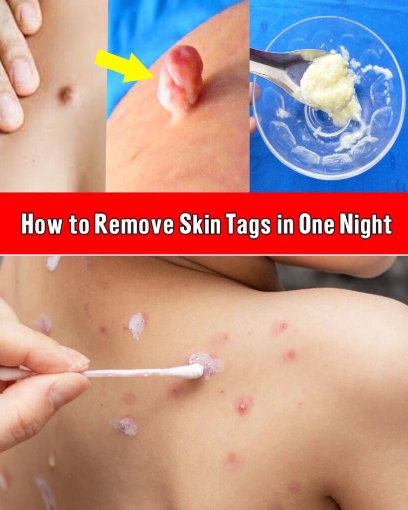How to Remove Skin Tags in One Night Naturally at Home (Yes, Even With Something as Simple as Vaseline)