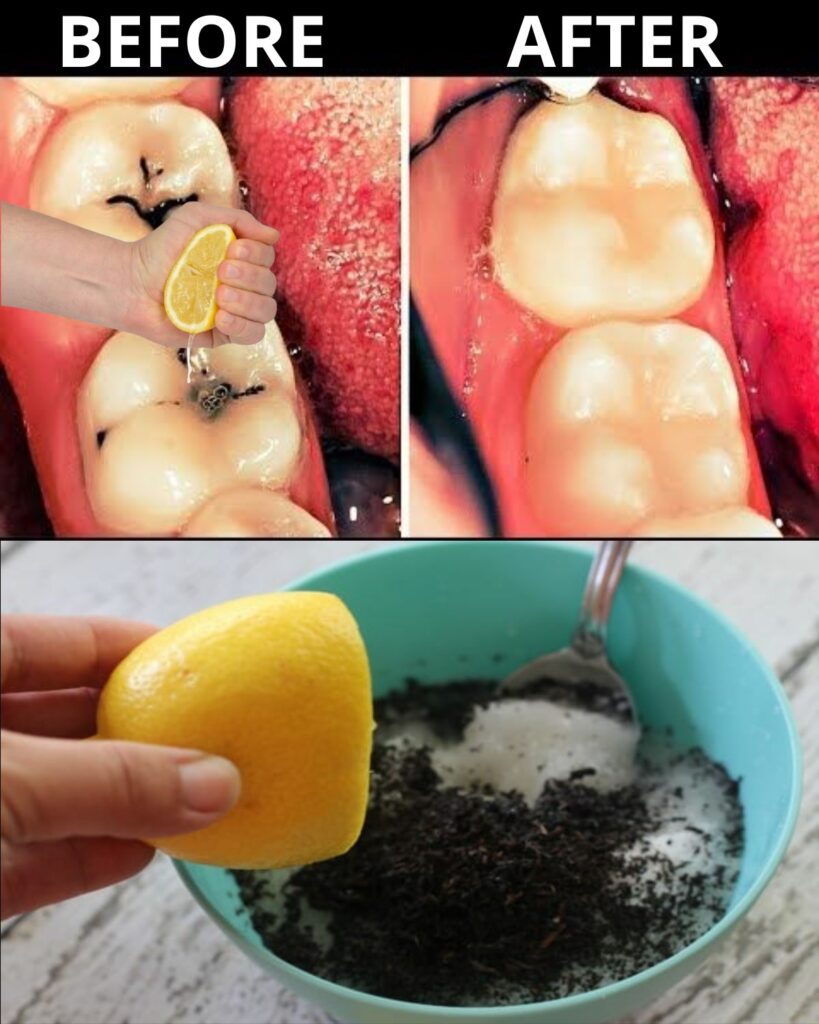 How to Naturally Support Early Tooth Decay Repair and Avoid the Dentist’s Drill