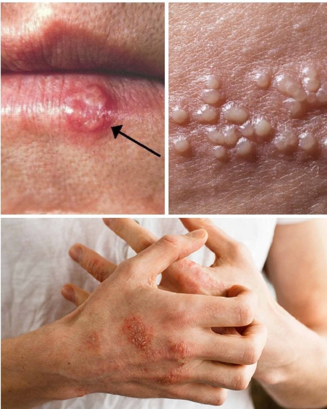 🚨 Recurrent Rashes or Blisters on Lips or Private Areas? This Is NOT Normal – Here’s What Your Body Is Telling You