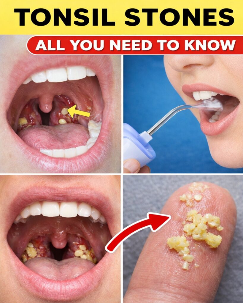 Tonsil Stones Unveiled: The Hidden Cause of Bad Breath and Throat Discomfort