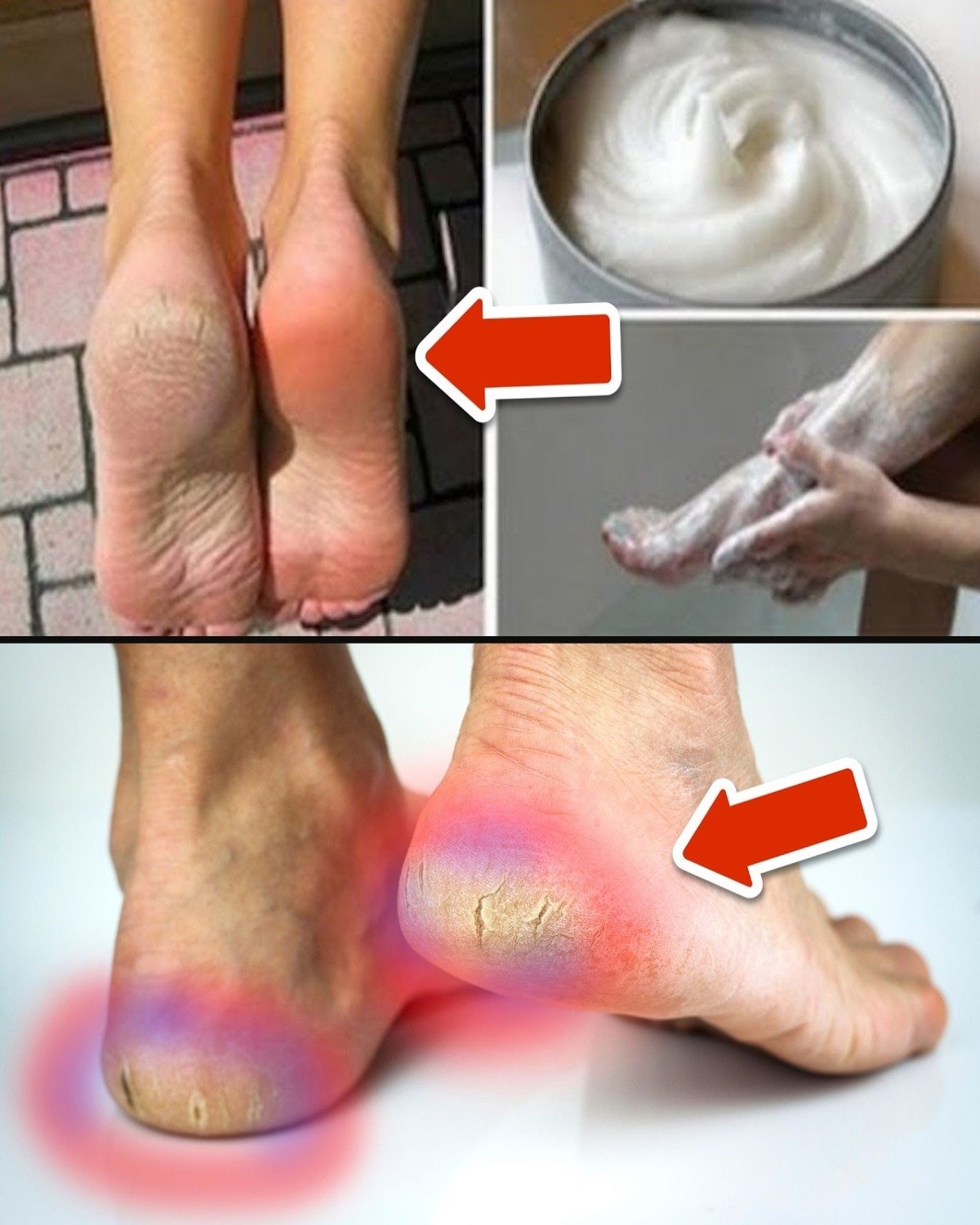 Cracked Heels Will Disappear Forever with These Home Remedies