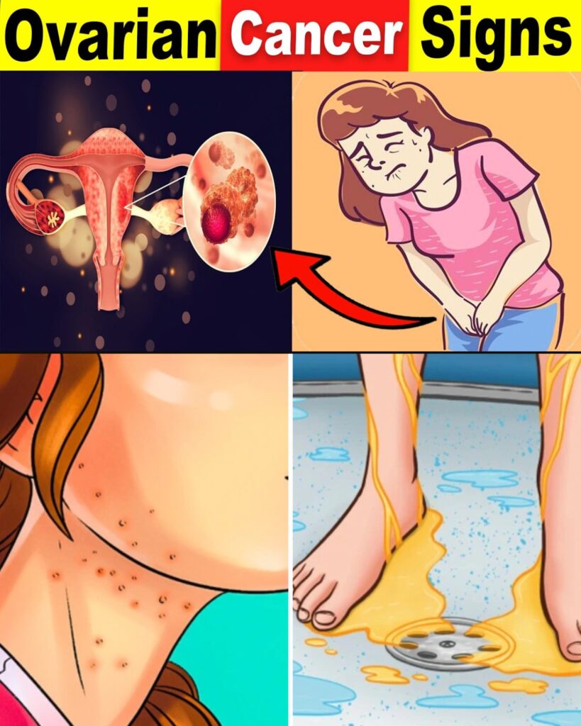 6 WARNING SYMPTOMS Of Ovarian Cancer