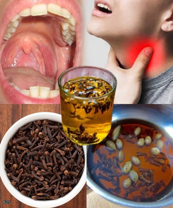 Cloves: Your Natural Remedy for Sore Throat Relief