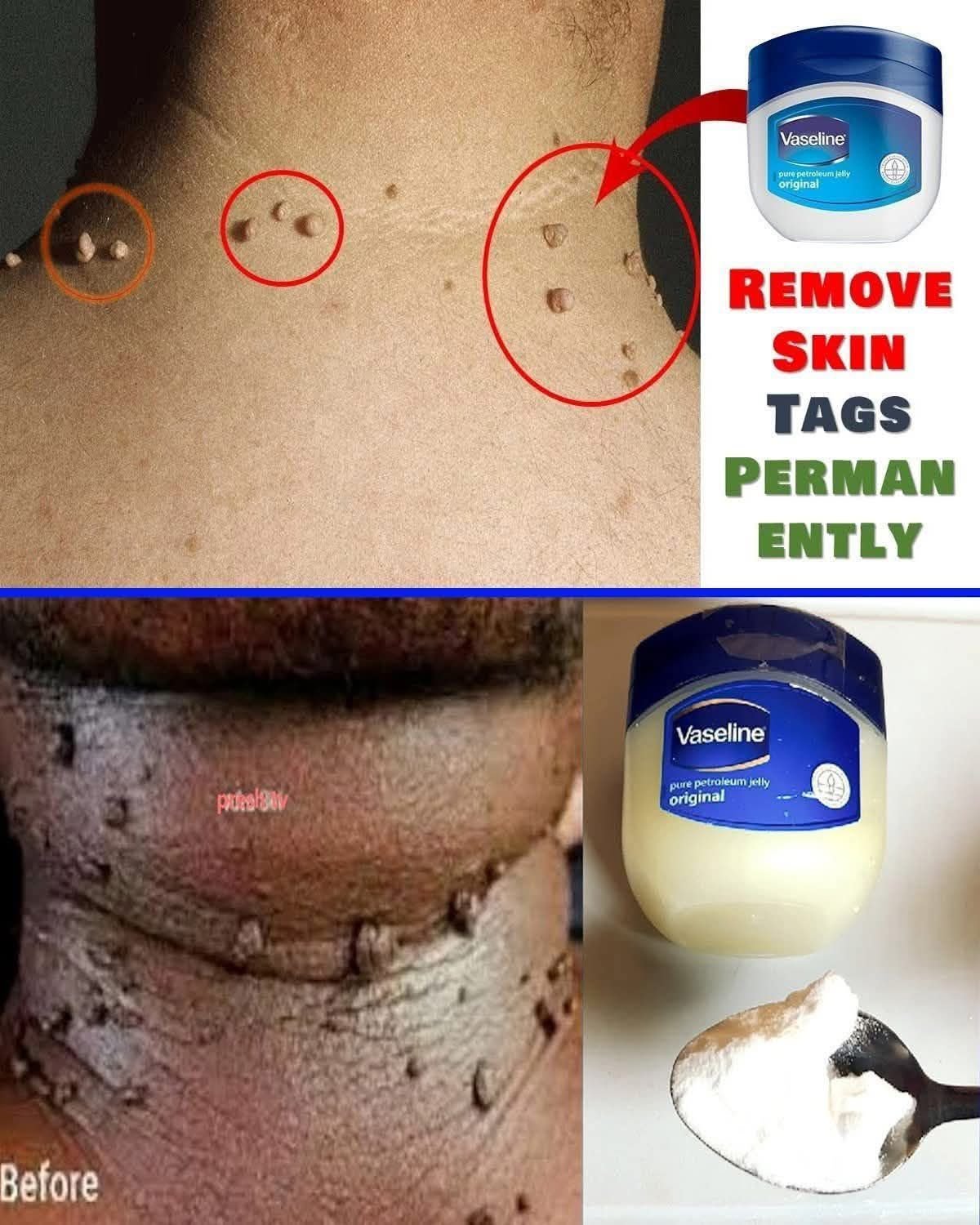 Cloves to Remove Skin Tags and Warts in One Night
