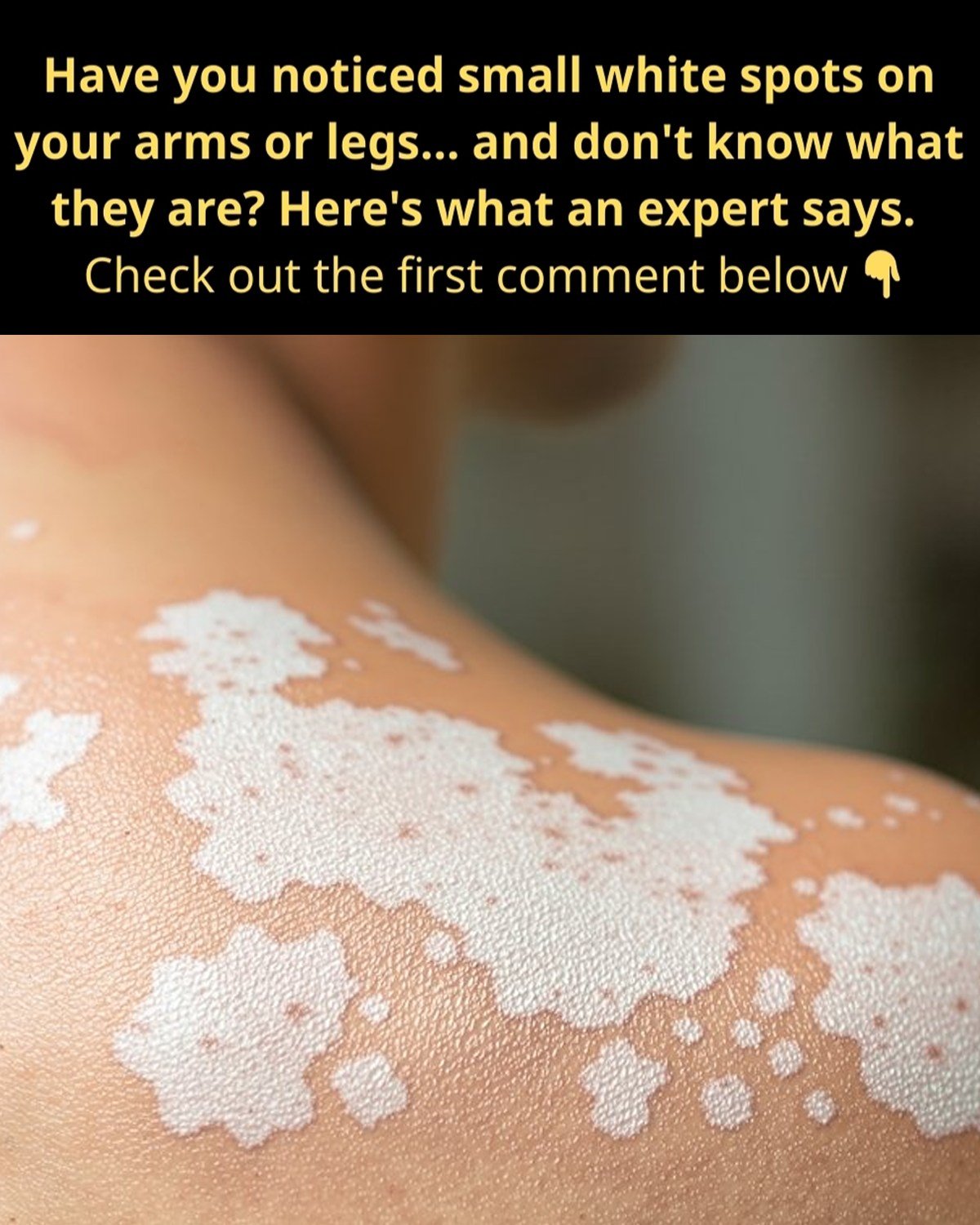 Why Do White Spots Appear on Your Skin? Hidden Causes You Shouldn’t Ignore