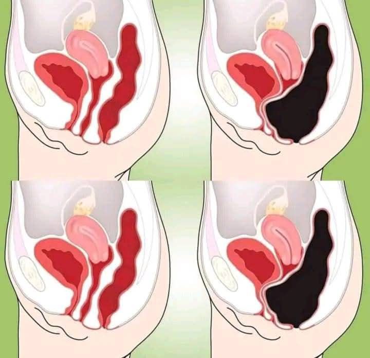 How to Cleanse Your Colon Naturally at Home (Colon Cleanse Smoothie)