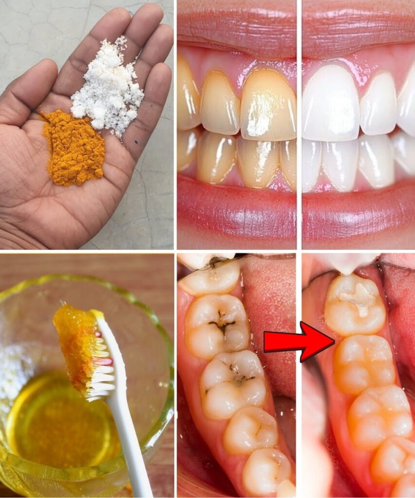 Turmeric for Teeth Whitening: Does This Natural Remedy Really Work?