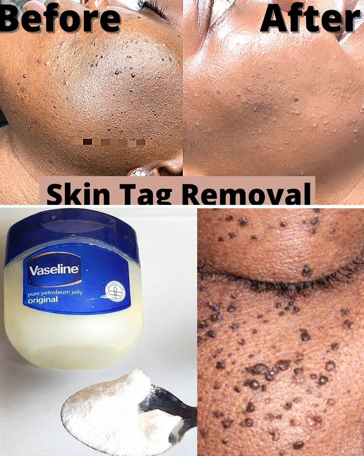 Those Stubborn Little White Bumps: Understanding Milia and Safe Ways to Improve Your Skin’s Appearance