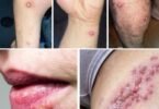 Recurrent Rashes or Blisters on Lips or Private Areas? This Is NOT Normal – Here’s What Your Body Is Telling You