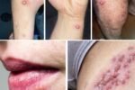 Recurrent Rashes or Blisters on Lips or Private Areas? This Is NOT Normal – Here’s What Your Body Is Telling You