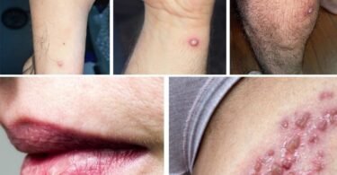 Recurrent Rashes or Blisters on Lips or Private Areas? This Is NOT Normal – Here’s What Your Body Is Telling You